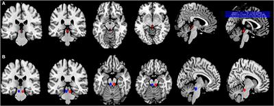 Decreased Resting-State Functional Connectivity of Periaqueductal Gray in Temporal Lobe Epilepsy Comorbid With Migraine